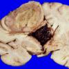 25A1 Glioblastoma (Case 25) 1