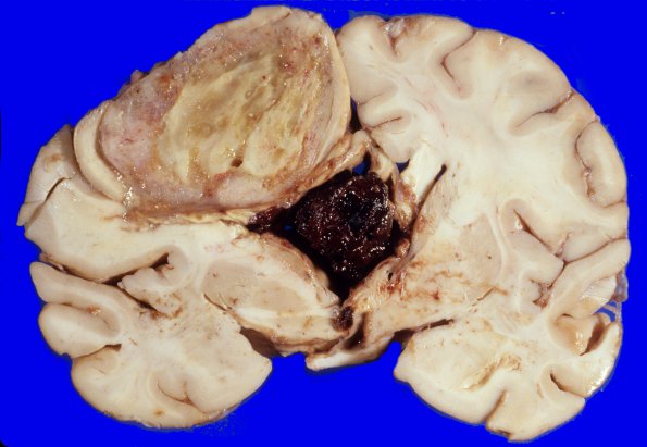 25A1 Glioblastoma (Case 25) 1