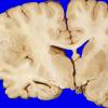 26A1 Glioblastoma (Case 26) 2