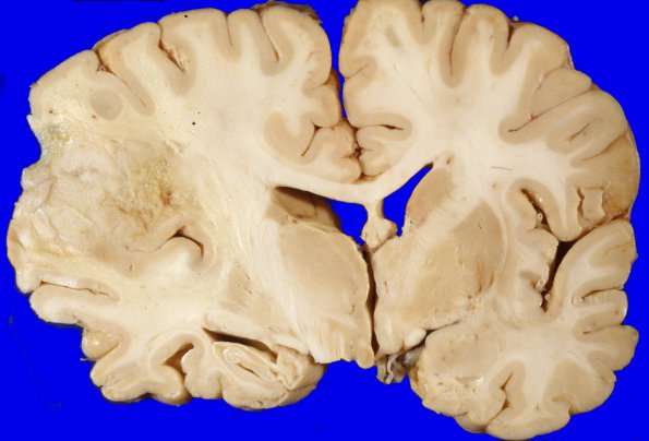 26A1 Glioblastoma (Case 26) 2