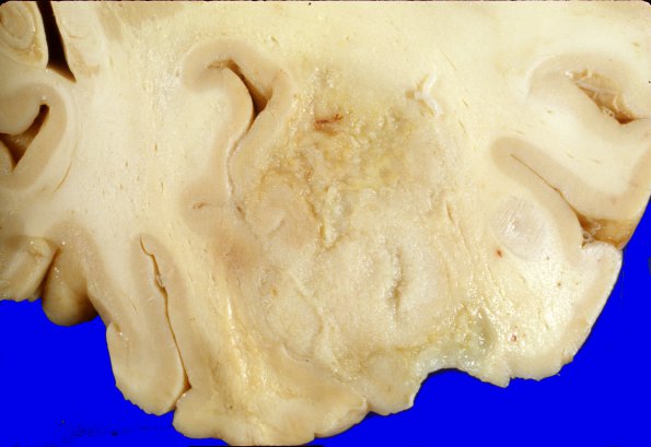 26A2 Glioblastoma (Case 26) 3