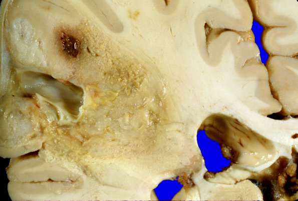 26A3 Glioblastoma (Case 26) 1