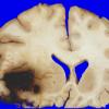 27A1 Gliomatosis cerebri, focal GBM (Case 27) 5