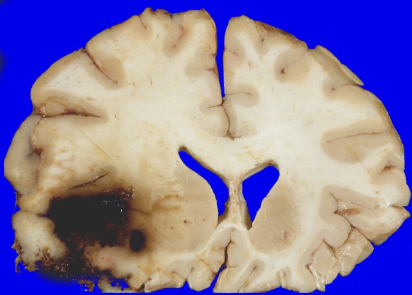 27A1 Gliomatosis cerebri, focal GBM (Case 27) 5