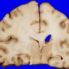 27A2 Gliomatosis cerebri, focal GBM (Case 27) 4