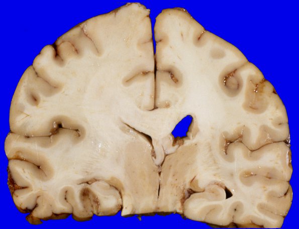 27A2 Gliomatosis cerebri, focal GBM (Case 27) 4