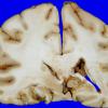 27A3 Gliomatosis cerebri, focal GBM (Case 27) 10