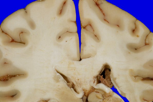 27A4 Gliomatosis cerebri, focal GBM (Case 27) 11