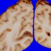 27A5 Gliomatosis cerebri, focal GBM (Case 27) 2