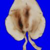 27A6 Gliomatosis cerebri, focal GBM (Case 27) 3 copy