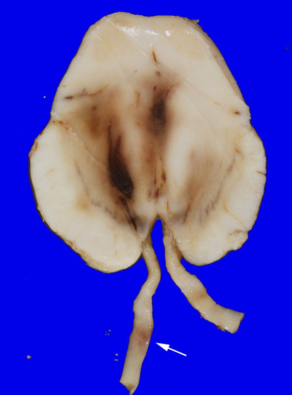 27A6 Gliomatosis cerebri, focal GBM (Case 27) 3 copy