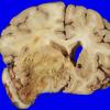 28A1 Glioblastoma (Case 28) & irradiation 2