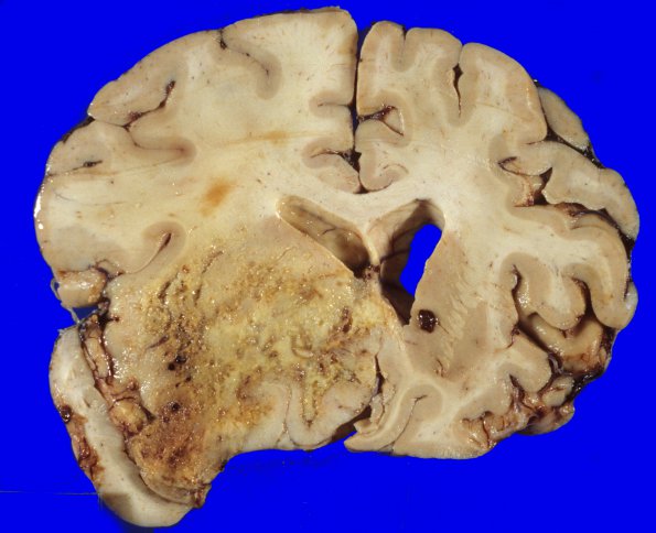 28A1 Glioblastoma (Case 28) & irradiation 2