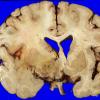 28A2 Glioblastoma (Case 28) & irradiation 1