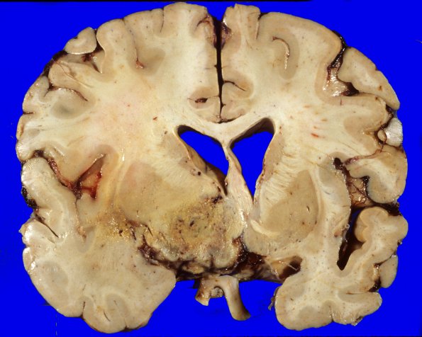 28A2 Glioblastoma (Case 28) & irradiation 1