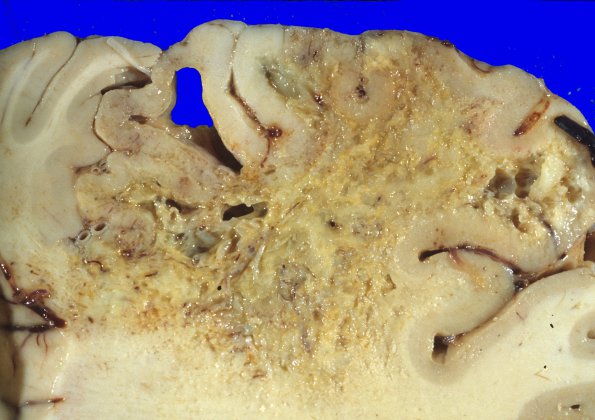 28A3 Glioblastoma (Case 28) &+ irradiation 3