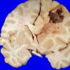 29A1 Glioblastoma (Case 29) gross 2