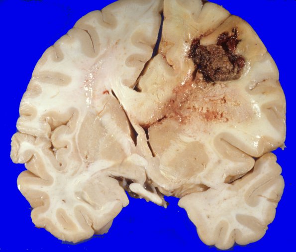 29A1 Glioblastoma (Case 29) gross 2