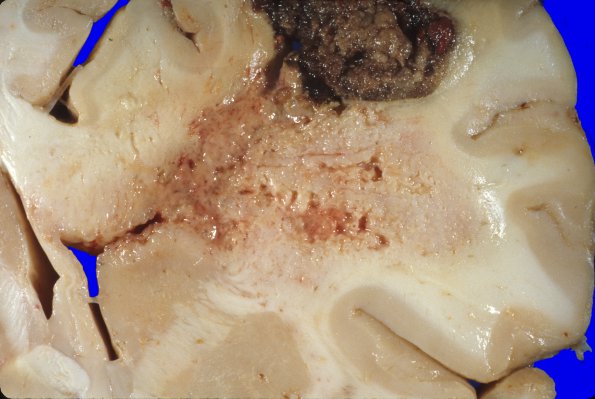 29A2 Glioblastoma (Case 29) gross 1