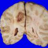 29A3 Glioblastoma (Case 29) 5