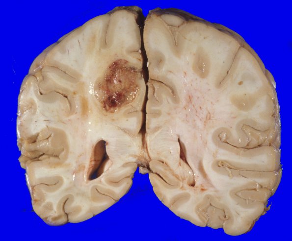 29A3 Glioblastoma (Case 29) 5