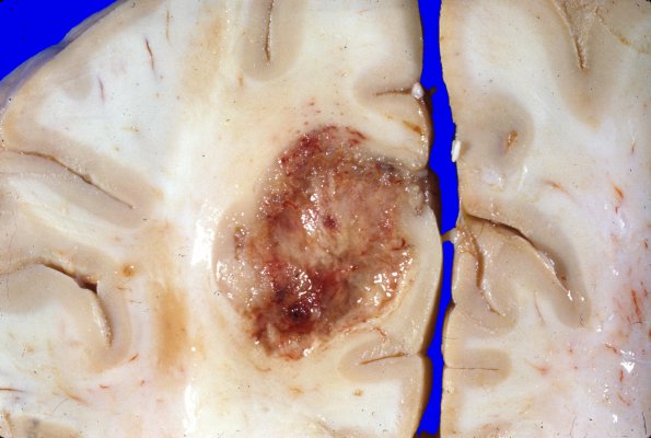 29A4 Glioblastoma (Case 29) gross 3