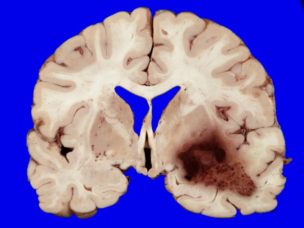 2A1 GBM (Case 2) 8