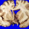 30A1 Glioblastoma (Case 30) 4