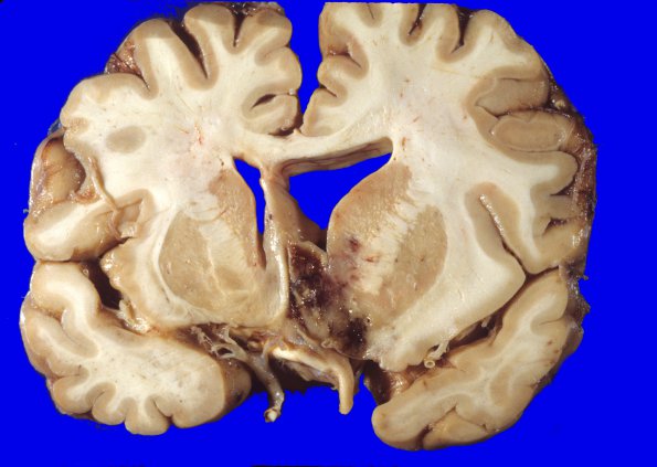 30A1 Glioblastoma (Case 30) 4