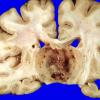 30A2 Glioblastoma (Case 30) 3