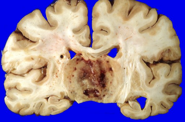 30A2 Glioblastoma (Case 30) 3