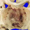 30A3 Glioblastoma (Case 30) 1