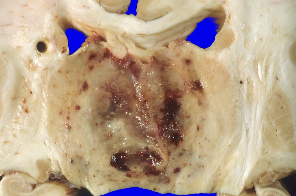 30A3 Glioblastoma (Case 30) 1