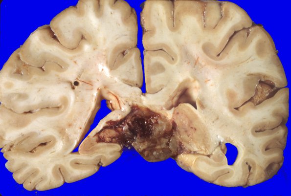 30A4 Glioblastoma (Case 30) 6