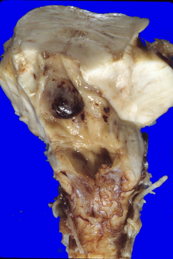 30A5 Glioblastoma (Case 30) 2A