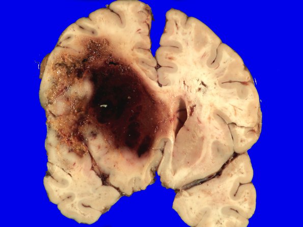 3A1 GBM IDHWT (Case 3) _1 (2)