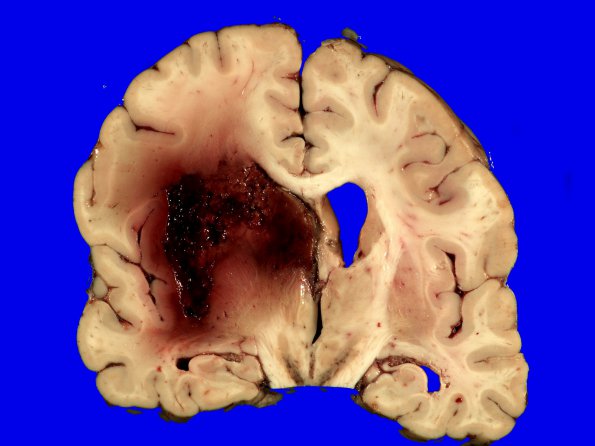 3A2 GBM IDHWT (Case 3) _3