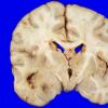 5A1 Glioblastoma (Case 5) 2