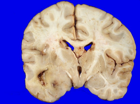 5A1 Glioblastoma (Case 5) 2