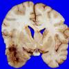 5A3 Glioblastoma (Case 5) 1