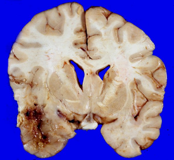 5A3 Glioblastoma (Case 5) 1