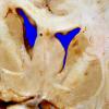 5A4 Glioblastoma (Case 5) 2A