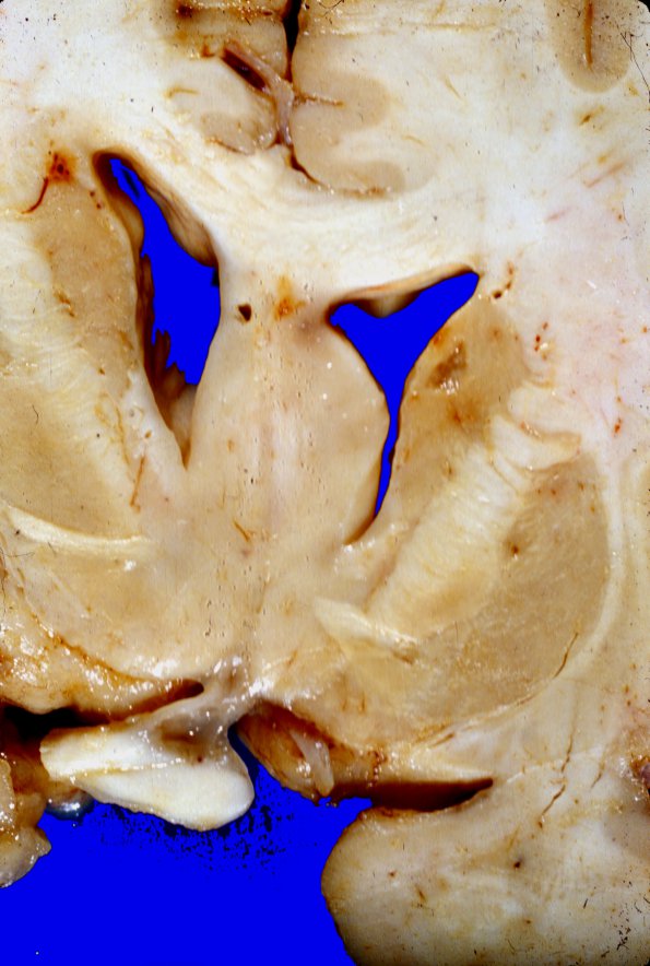 5A4 Glioblastoma (Case 5) 2A