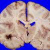 5A5   Glioblastoma (Case 5) 4