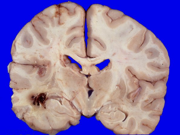 5A5   Glioblastoma (Case 5) 4