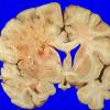 6A1 Glioblastoma (Case 6) 3