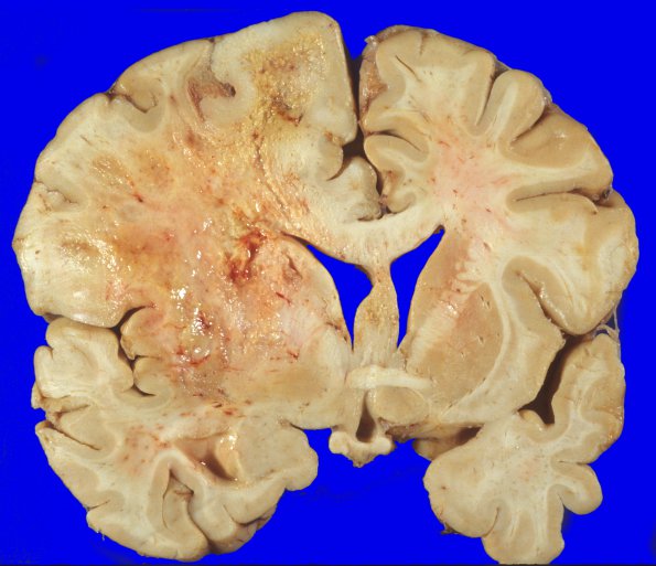 6A1 Glioblastoma (Case 6) 3