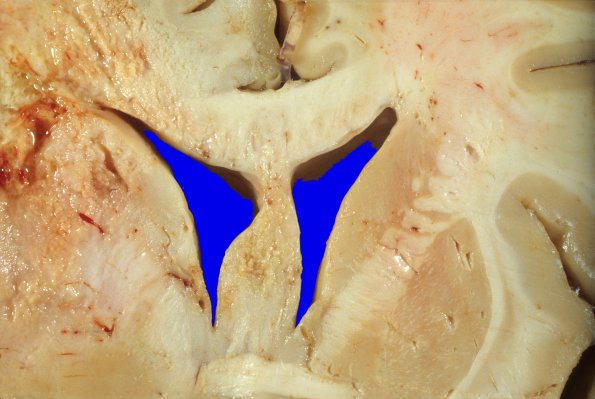 6A2 Glioblastoma (Case 6) 1