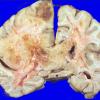 6A3 Glioblastoma (Case 6) 1 (2)