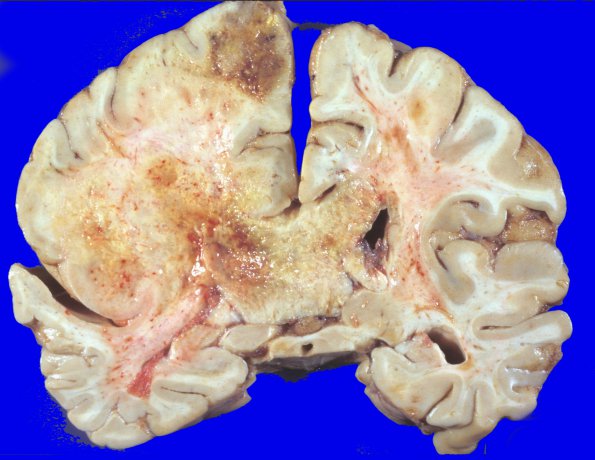 6A3 Glioblastoma (Case 6) 1 (2)